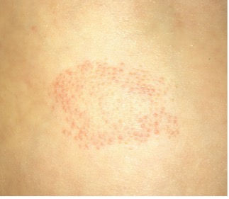 an-atlas-of-lumps-and-bumps-part-39-lichen-spinulosus-consultant360